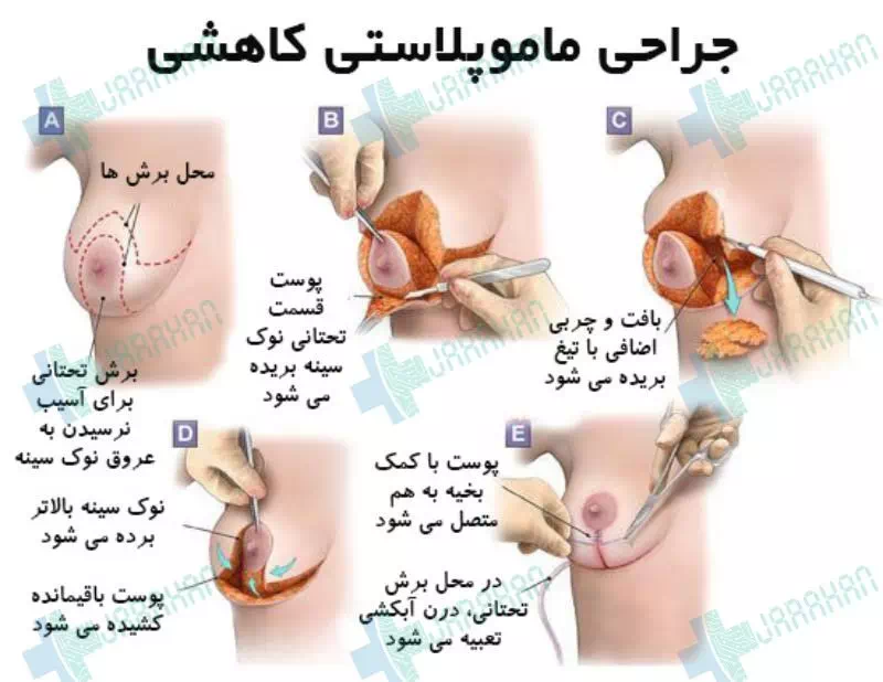 مراحل عمل ماموپلاستی